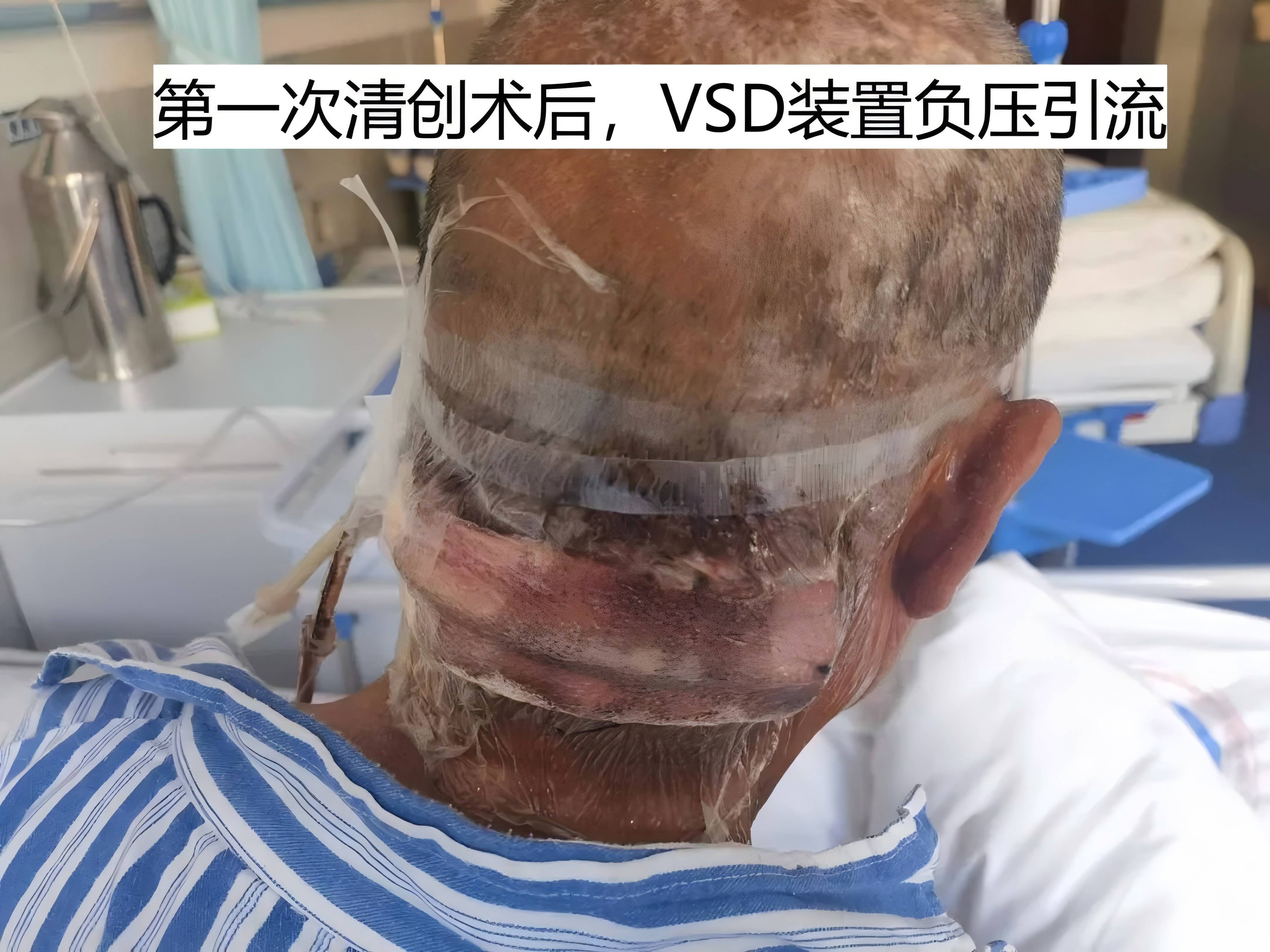 vsd第一次清創(chuàng)(1).jpg